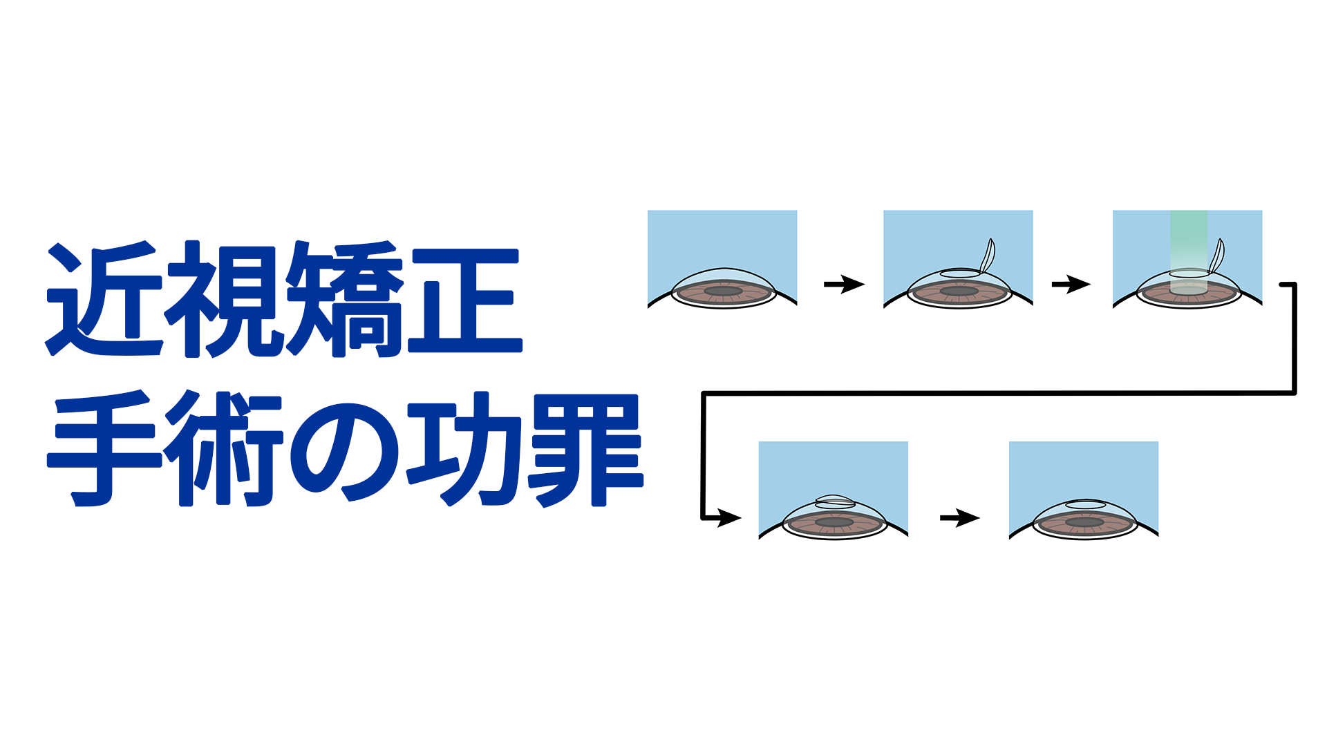 近視矯正手術の功罪 | 中野眼科｜JR中野駅徒歩5分｜白内障 緑内障 眼底